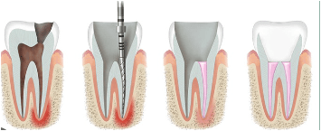 Teeth Whitening